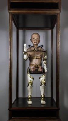 Phocomelic Child With Prosthetic Limb Apparatus by Jesse Berlin